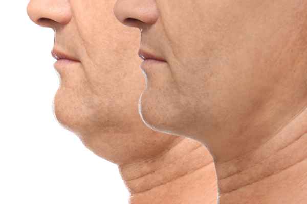 HIFU - Breakthrough in Anti - ageing 2 hifu results Bexleyhill