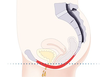 Pelvic-Floor Muscle Repair 5 Pelvic floor muscles Bexleyhill