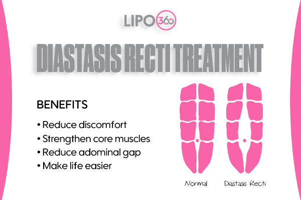 Revolutionising Muscle Repair: The Power of LIPO360 Body Sculpt Post-Injury 5 diastasis recti treatment Bexleyhill