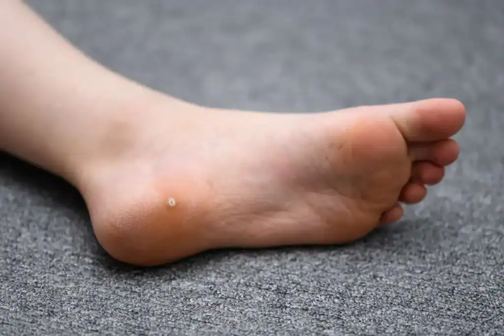 Cryotherapy For Warts And Also Verrucas 2 Image of verruca on the bottom of the foot that able to be treated with Cryotherapy Bexleyhill