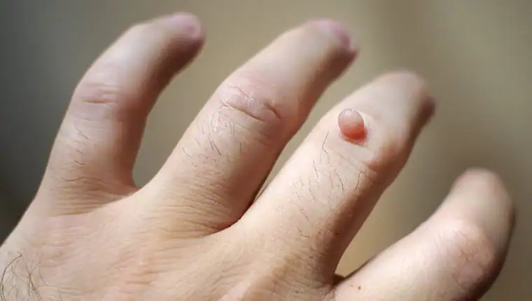 Image of blemish that Cryotherapy Bexleyhill can remove with Lipo 360.
