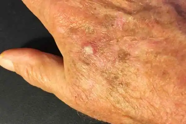 Image of Actinic keratoses Bexleyhill on a person hand