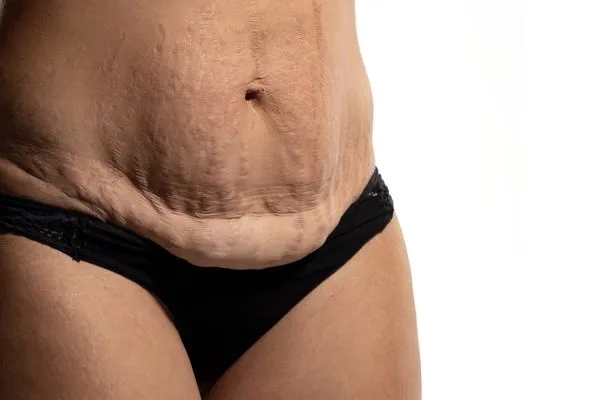 The science behind skin tightening Bexleyhill picture of a woman's sagging skin on the stomach